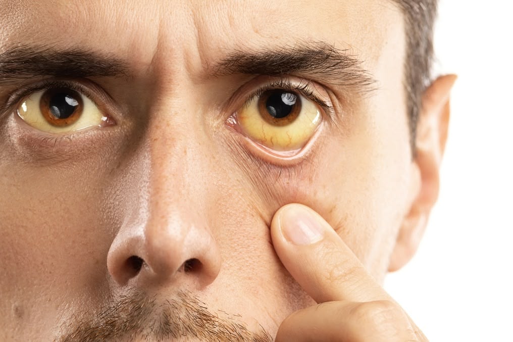 a man showing her yellow eyes because of excessive drinking